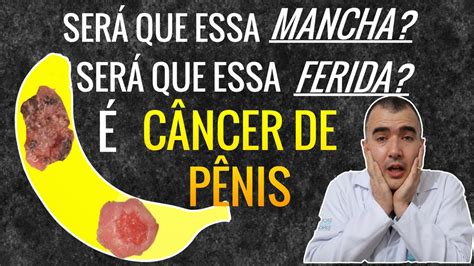 câncer de penis-1